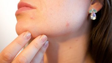 Study: People With Pimples Less Likely To Be Hired